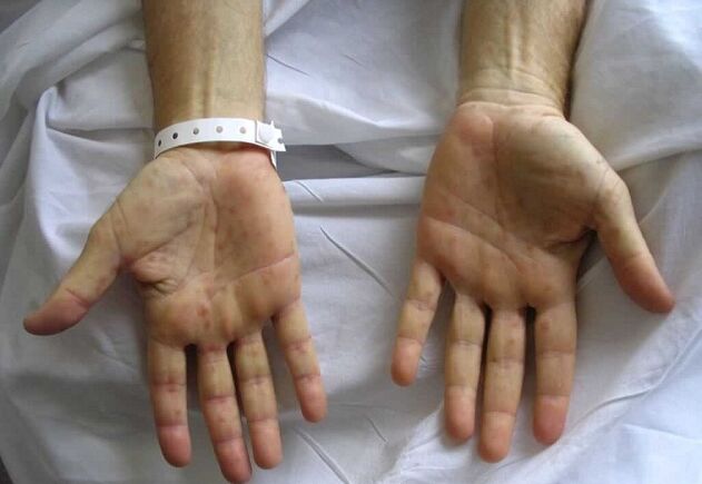 tsifilis ar na lámha mar chúis le scaoileadh paiteolaíoch ón bod